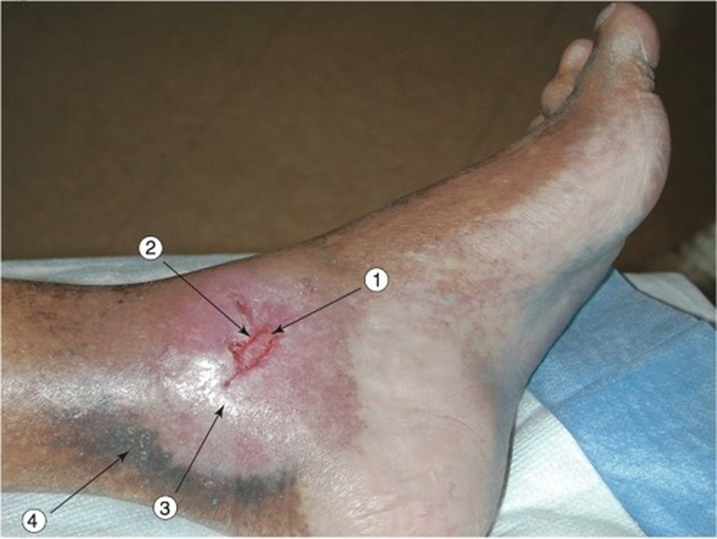 <p>DVT</p><p>Thrombophlebitis</p><p>Valvular incompetency</p><p>Venous HTN</p><p>Muscle pump ineffective</p>