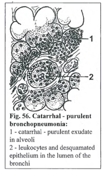 <p><strong>Bronchopneumonia purulenta</strong></p><p><em>note: from left: bruncus (round strunctures), high amount of air in the lungs are seen in middle picture, infiltrate in lumen of alveoli while normal at the top, at right: vicarious emphysema</em></p>