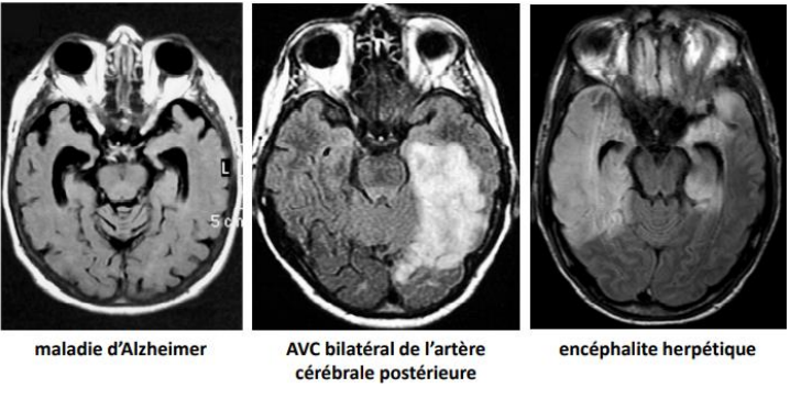 Il s’agit ici du même type d’amnésie mais la lésion est à des endroits différents du réseau. Par exemple, les lésions de la maladie d’Alzheimer sont situées au niveau du mésiotemporal avec une atrophie des hippocampes.
Autres étiologies : encéphalites limbiques paranéoplastiques ou auto-immunes, épilepsie temporale (ex : SMT), encéphalopathie postanoxie, traumatisme crânien, ictus amnésique,…