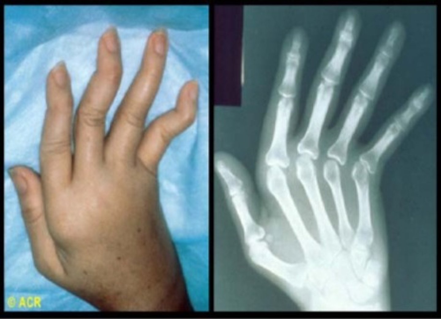 <p>joint disease</p>