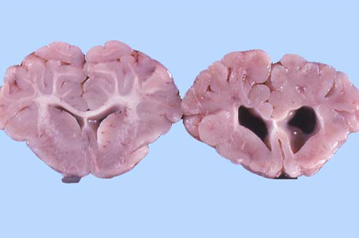 <p>&nbsp;</p><p class="MsoNormal">12.&nbsp; Tissue from a neonatal lamb. (Normal on left).&nbsp; What is the most likely cause of this lesion?</p><p class="MsoNormal"></p><ol><li><p class="MsoListParagraph">Copper deficiency (dam)</p></li><li><p>Hypothyroidism (dam)</p></li><li><p>Ovine pestivirus (in utero infection)</p></li><li><p><em>Veratrum californicum</em> ingestion (dam)</p></li></ol><p></p>