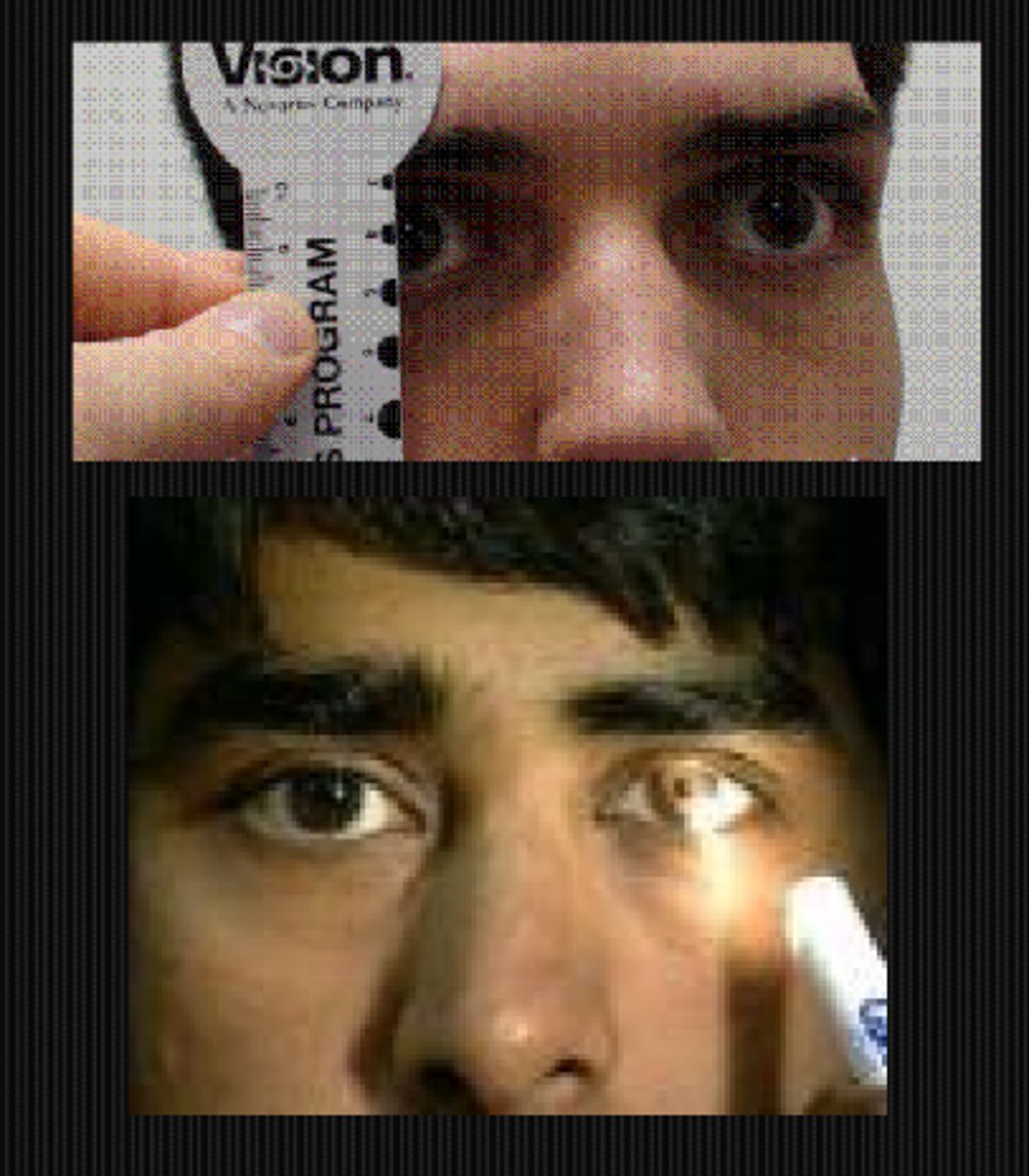 <p>APD</p><p>anisocoria = physiological if equal in bright and dim light, parasymp issue if aniso greater in bright light, symp issue if ansio greater in dim light, tonic pupil if same pupil is larger in bright and smaller in dim </p>