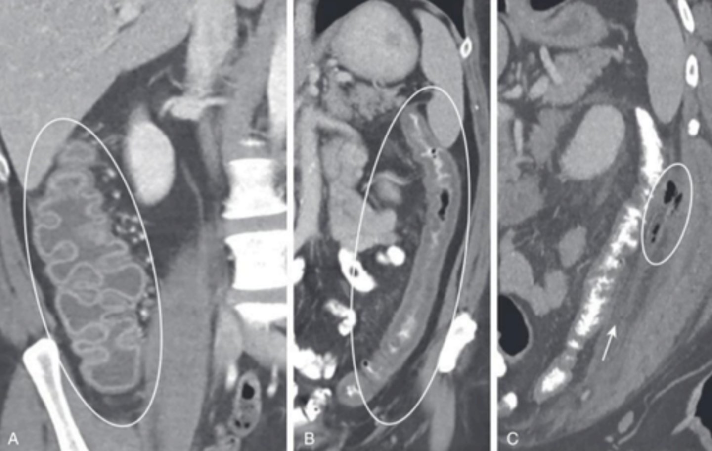 <p>management of intussusception</p>