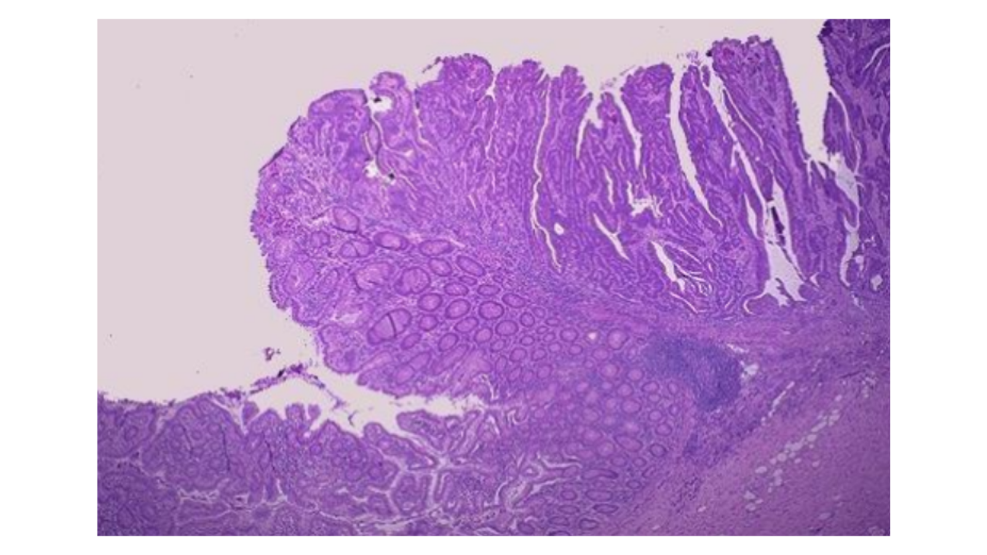 <p>Colon Adenocarcinoma</p>