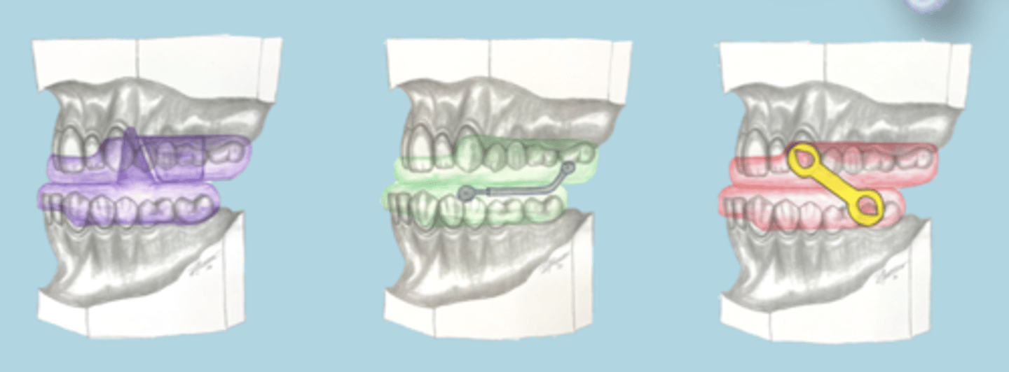 <p>- Bilateral traction</p><p>- Bilateral compression</p><p>- Bilateral interlocking</p><p>- Midline traction</p>