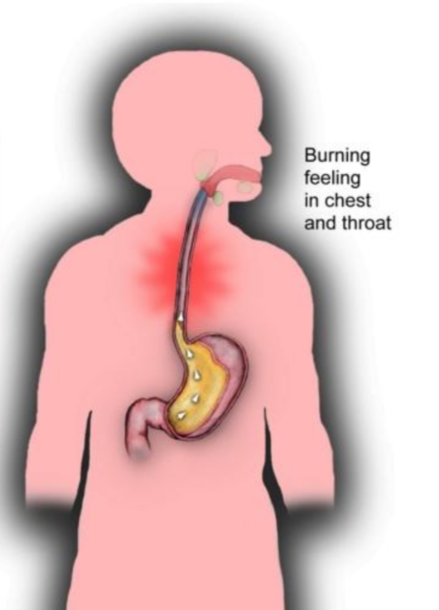 <p>Acid reflux- acid moving up the esophagus</p>