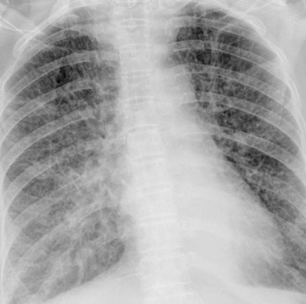 <p>alveolar pneumonia with air bronchogram</p>