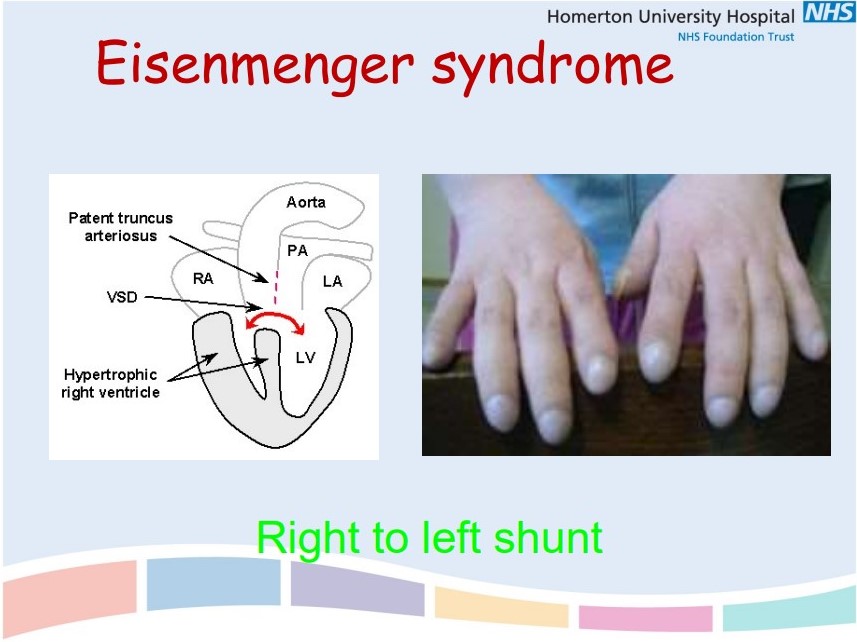 **Hypoventilation** (asthma, COPD, motor neurone disease, obesity)

\
**Diffusion abnormality** (pulmonary fibrosis, sarcoidosis, COPD)

\
**V/Q mismatch** (lobar pneumonia, asthma, PE, pneumothorax)

\
**Right to left cardiac shunt** (patent truncus arteriosus)

\
**Low inspired O2** (high altitude, air-flight)
