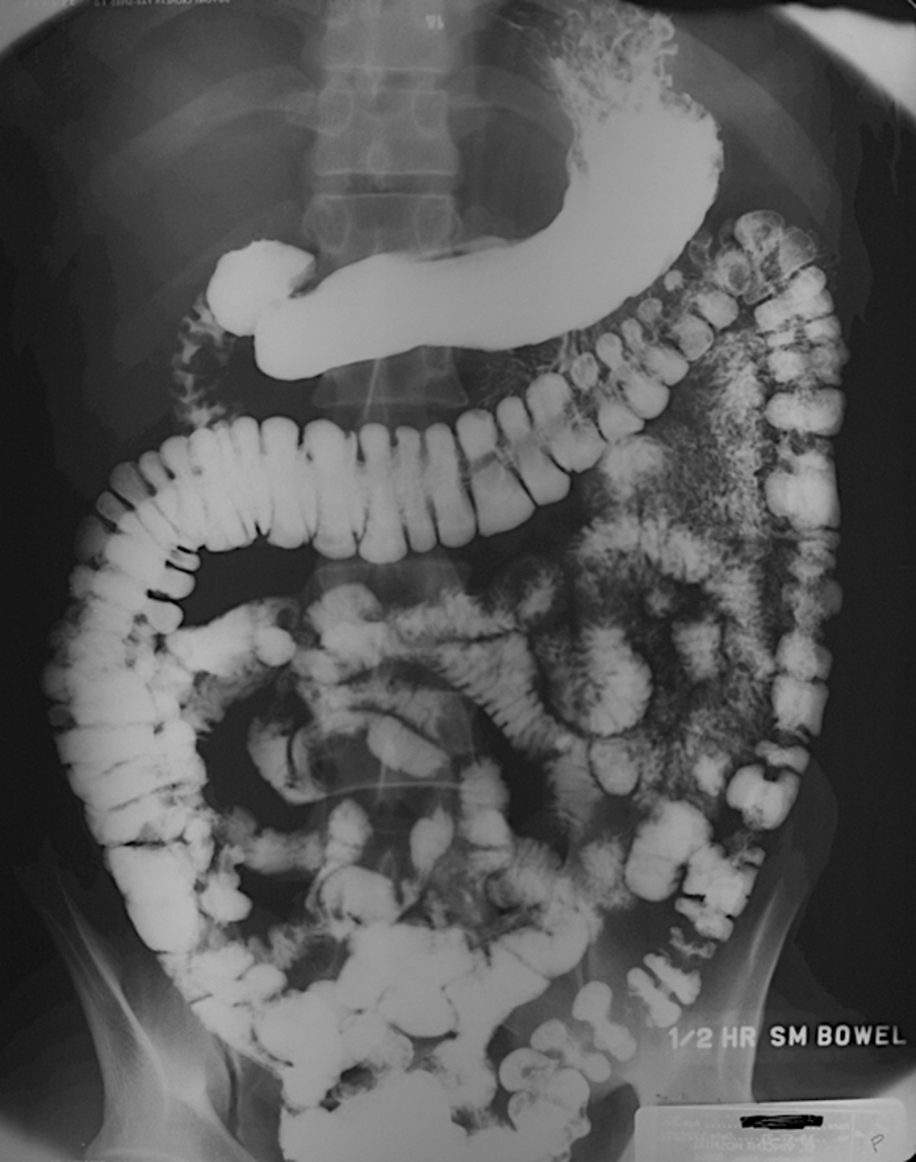 <p>pt drinks barium contrast, and the barium goes though allow visiualiization of entire upper GI tract</p>
