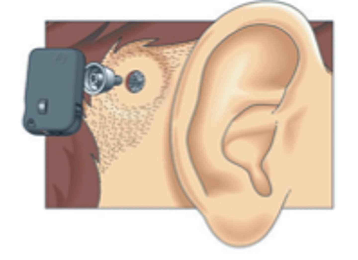 <p>a device that transmits sound vibrations through the skull directly to the inner ear via bone conduction, bypassing the outer and middle ear</p>