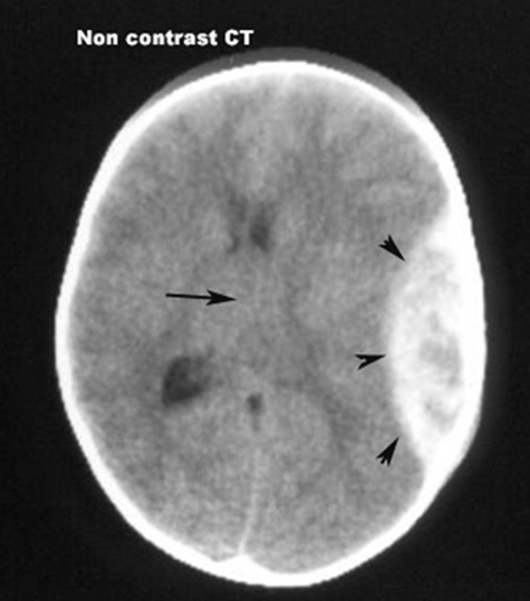 <p>lesión cerebral, daño cerebral</p>