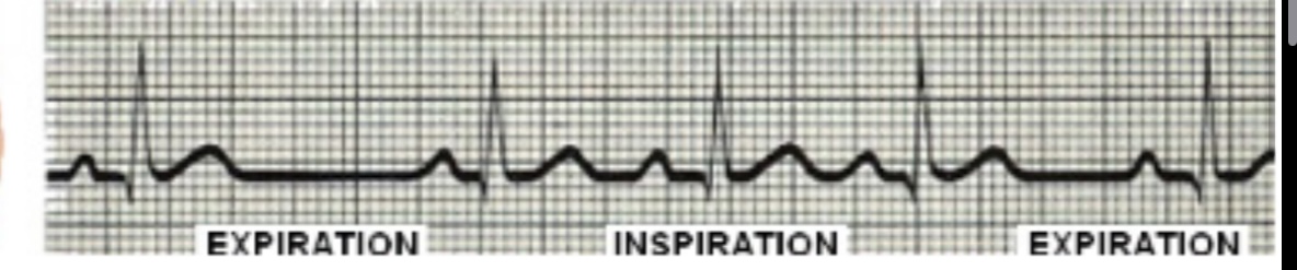 Normal sinus irregular rhythm