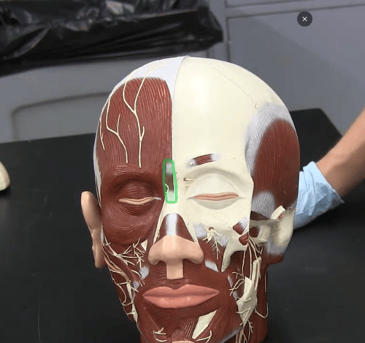 <p>Vertical striations running between orbicularis oculi.</p>