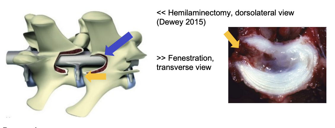 <p>hemilaminectomy procedure is performed o The articular facet joint and lamina of 2 (or more) adjacent vertebrae is removed to access the vertebral canal from the dorsolateral aspect (blue arrow) o Additionally a fenestration may be performed. A section of the lateral aspect of the annulus fibrosus is removed and the nucleus pulposus is curetted (scooped) out (yellow arrow)</p>