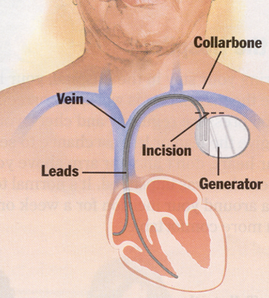 <p><u>Below the collarbone</u> and the leads are placed in</p>