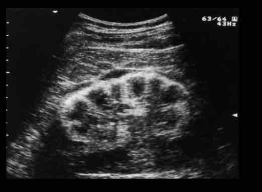 <p>What is <span>a diffuse or focal calcium deposition in the renal cortex?</span><br><span>• Risk factors--- Acute cortical necrosis, Chronic glomerulonephritis, Rejected renal</span><br><span>transplant.</span></p>