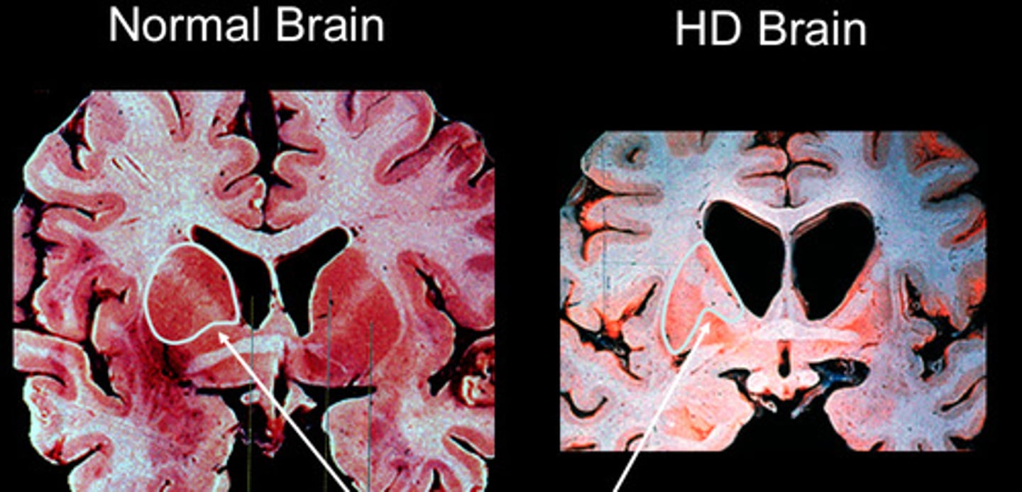 <p>Huntington disease (AD, CAG repeat expansion)</p><p>Hemiballismus caused by subthalamic nuclei (STN)</p><p>Loss of GABAergic neurons</p>