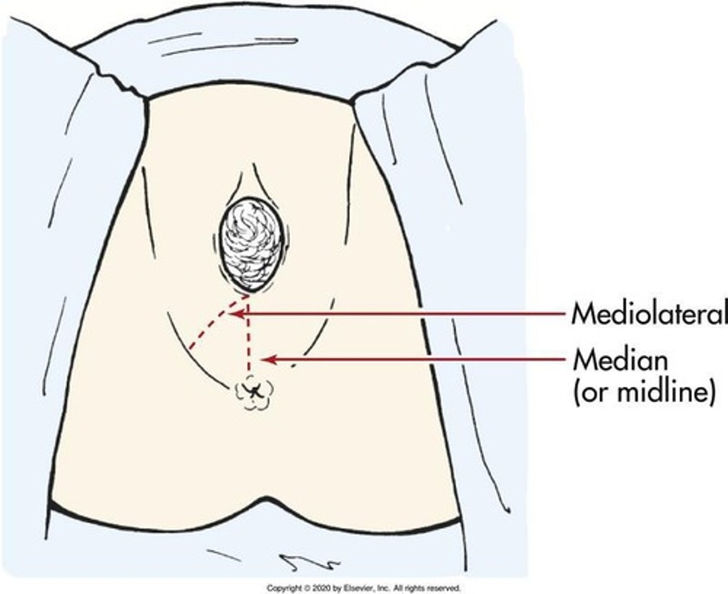 <p>An incision made in the perineum to enlarge the vaginal outlet during delivery.</p>