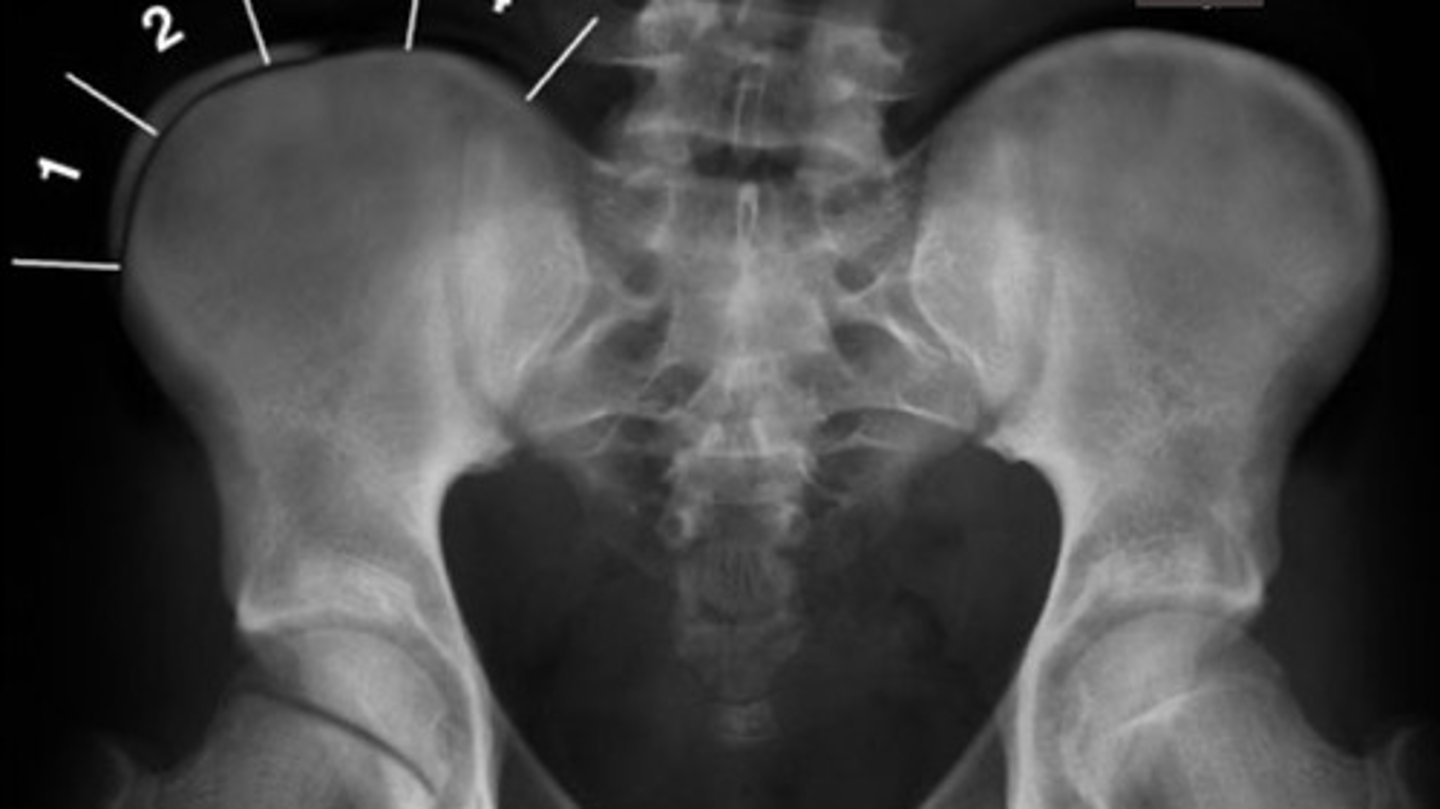 <p>What grade Risser sign is this, on the patient's left?</p>