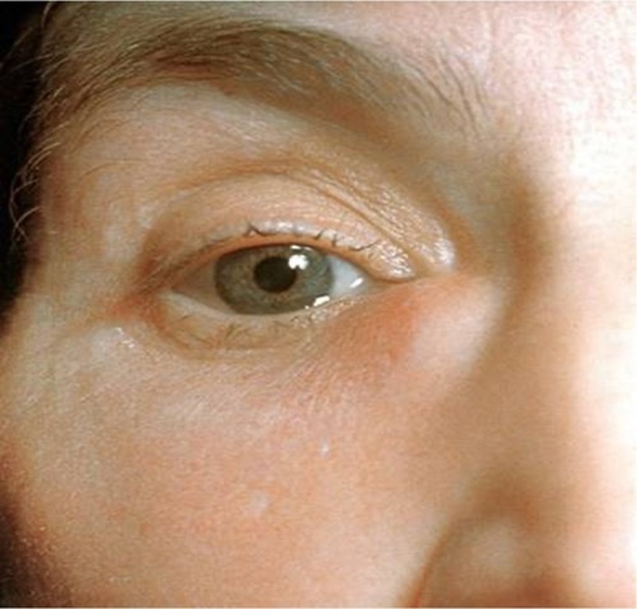 <p>an abscess resulted from pus in canaliculi</p><p>(dacry/o- = nasal lacrimal system)</p>
