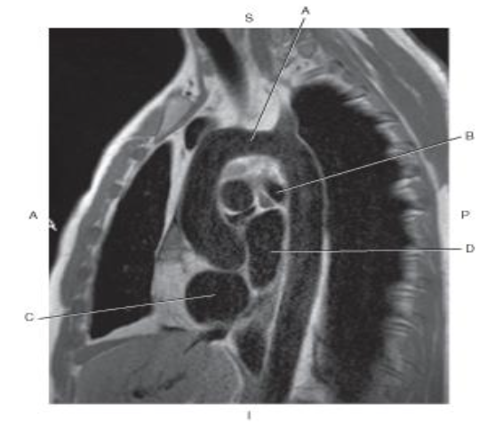 <p>Which line points to the <span style="color: blue">left mainstem bronchus?</span></p>