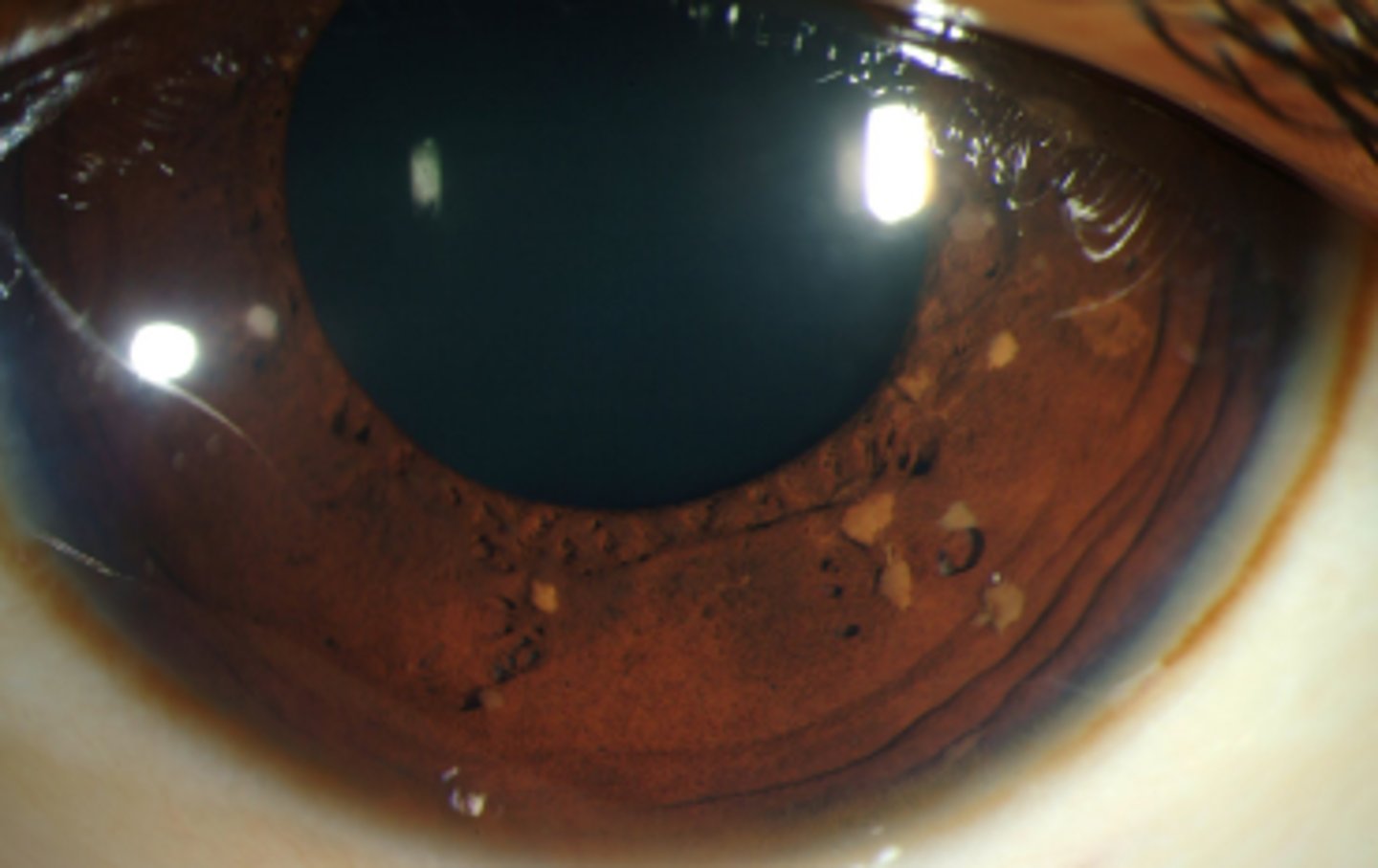 <p>tan (varying depending on eye color) melanocytic progressive growths on the iris associated with neurofibromatosis 1.</p>