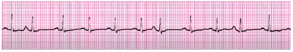 <p>treat underlying cause if sx</p><p>BBs, Ca Channel Blockers, anti-anxiety meds</p><p>monitor someone with LOTS of PACs, could turn into atrial dysrhythmia</p>