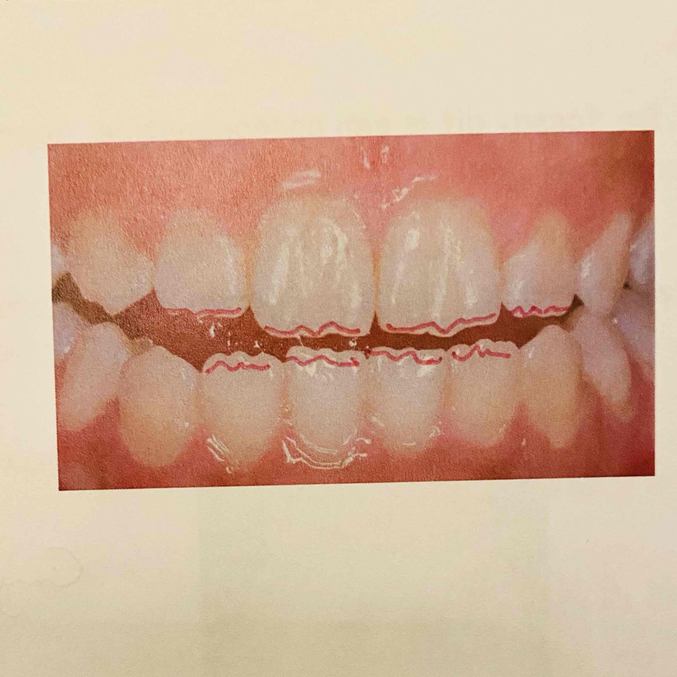 <p>Kleine afgeronde projectie vh glazuur thv de incisale rand bij een nieuw doorgebroken anterieure tand.</p>