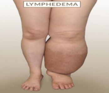 <p>Non-Pitting edema </p><p> Caused by inflammatory edema and lymphedema.</p>