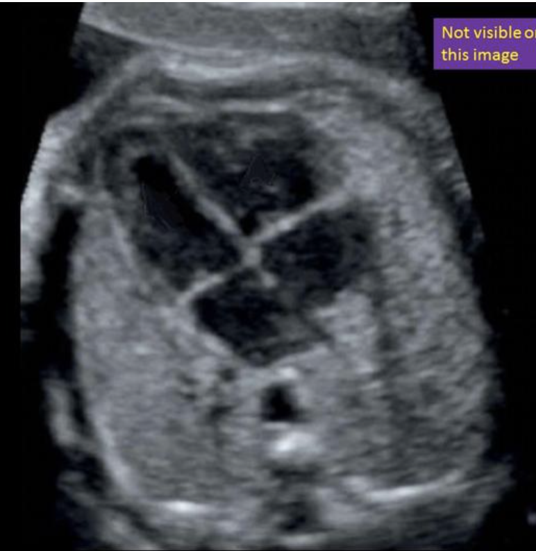 <p>where is the foramen ovale</p><p>a) between the 2 atrium</p><p>b) between the 2 venticle</p><p>c) between the left atria + ventricle</p><p>d) between the right atria + ventricle </p>