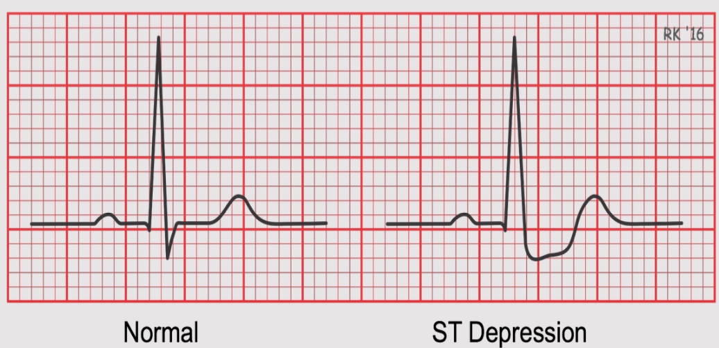 <p>when the ST does not come back to baseline&nbsp;</p><ul><li><p>heart is not getting enough oxygen&nbsp;</p></li><li><p>damage is not permanent and there are things that can be done&nbsp;</p></li></ul><p></p>