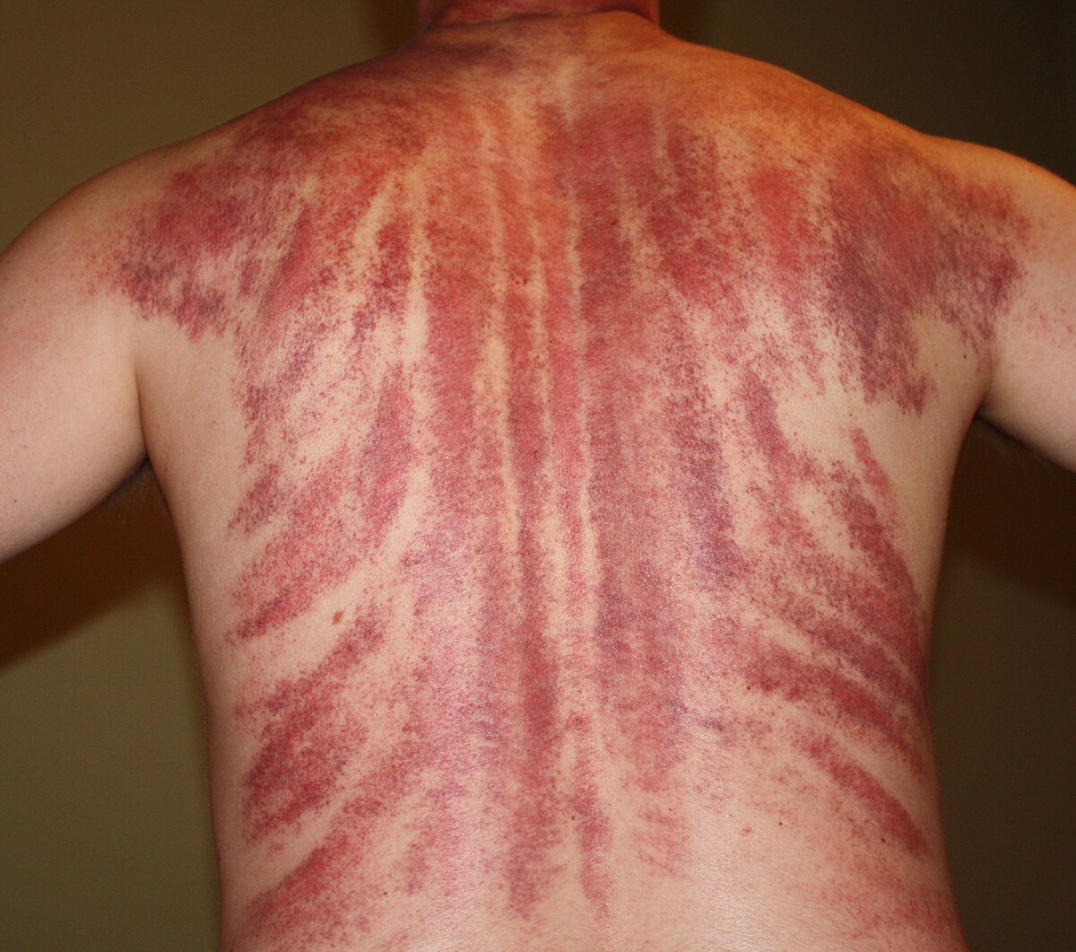 <p>Which type of TCM treatment has been done based on the picture?</p><p>a. cupping</p><p>b. acupuncture</p><p>c. gua sha</p><p>d. massage</p>