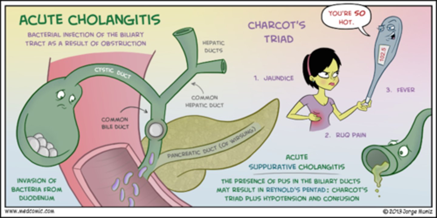 <p>RUQ abd pain</p><p>jaundice</p><p>fever with chills</p><p>assoc. with acute cholangitis</p>