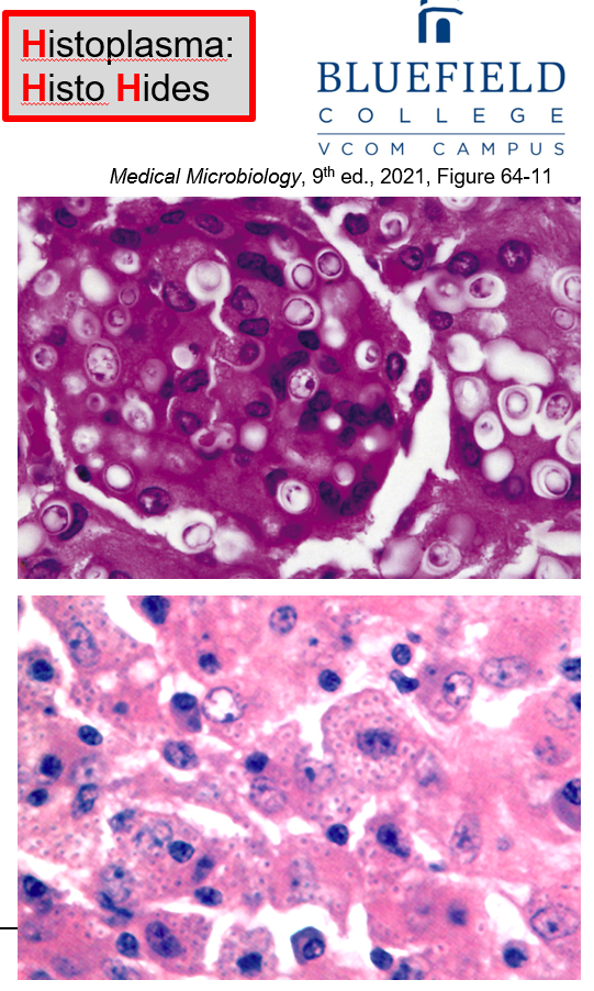 <p>How is <strong>Histoplasmosis </strong>diagnosed?</p>