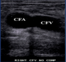 <p>What is site 1 for a DVT?</p>