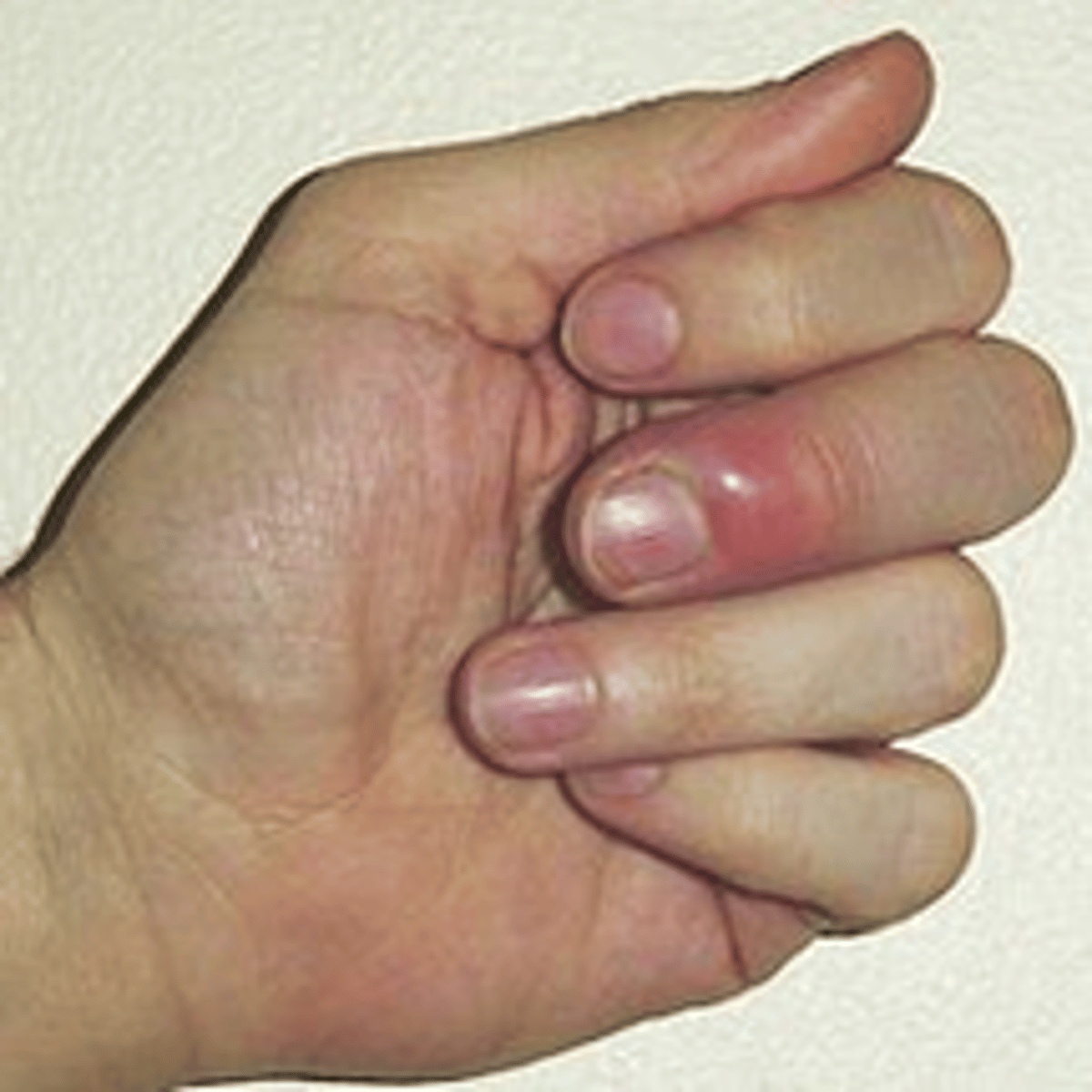 <p>cardinal signs: Redness (rubor), swelling (tumor), warmth (calor), and pain (dolor). The wound bed may appear glossy due to transudate or exudate.</p>