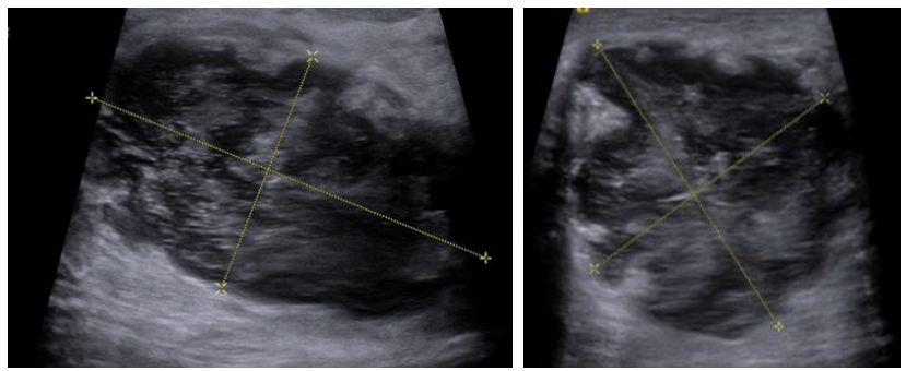 <p>What does the Ultrasound image show?</p>