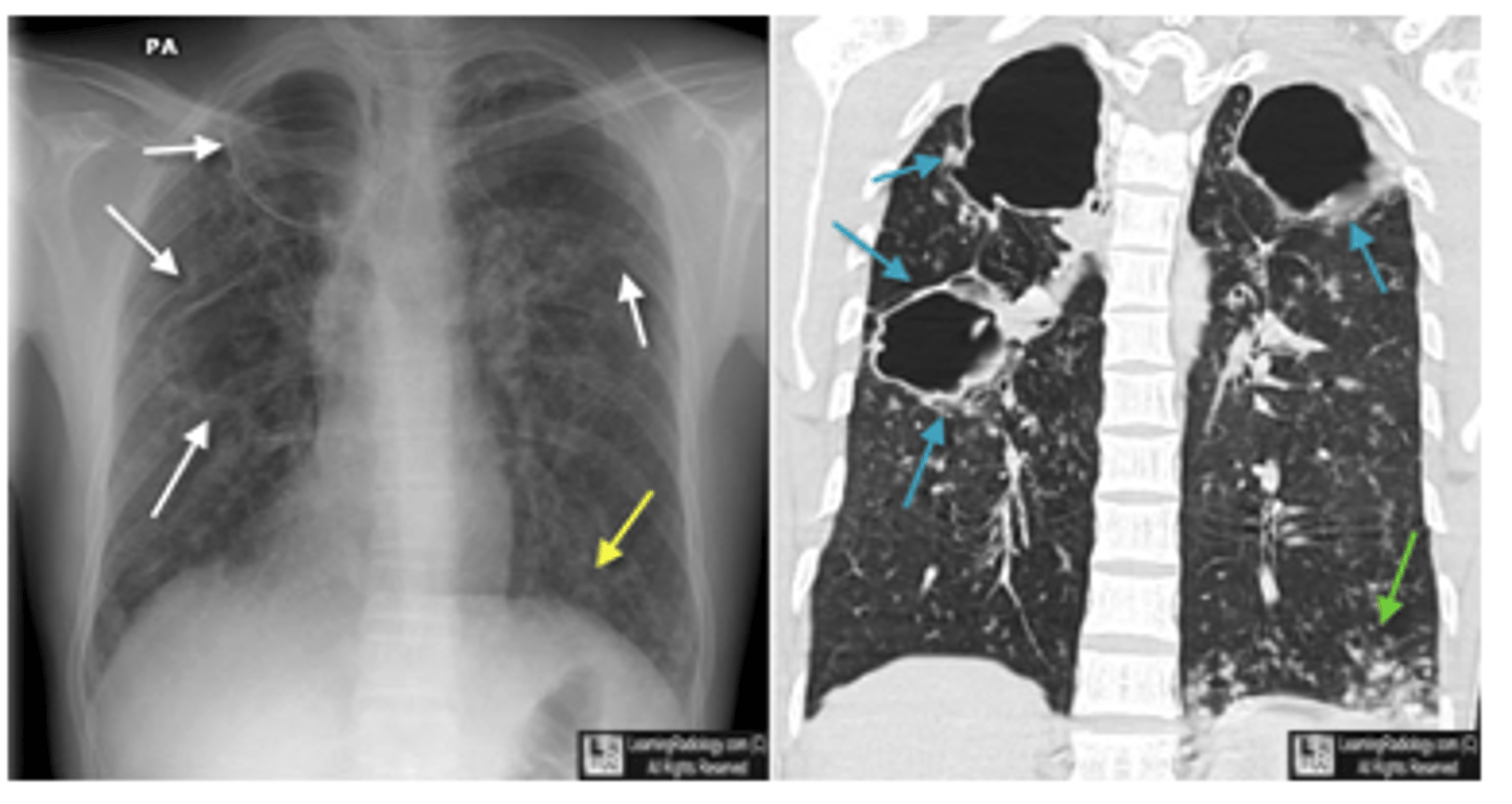 <p>oCavitary TB is also a late phase of TB.</p><p>oHealing leads to fibrososis and calcifications which may pull the hilum up on the affected side.</p><p>X-ray will have dark spots indicating holes/cavities</p>