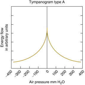 <ul><li><p>Normal middle ear function</p></li><li><p>“Normal box values” →</p><ul><li><p>-150 0 +50 daPa (x-axis)</p></li><li><p>Peak compliance: 0.2-1.8 cc (y-axis)</p></li></ul></li><li><p>Thre is absence of middle ear pathology</p></li><li><p>TM is mobile and intact</p></li><li><p>Eustachain tub function is normal</p></li><li><p>If there is hearing loss, it is likely sensorineural.</p></li></ul>