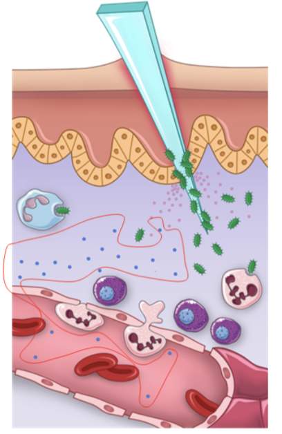 <ul><li><p>vasodilation, coupled with vasoconstriction of vessels carrying blood away, allows for accumulation of excess fluid at the site of infection, called exudate</p></li><li><p>the exudate fluid contains proteins that contribute to the mediation of the inflammatory response. It includes both pro-inflammatory cytokines, specifically a group called chemokines, and complement proteins that will be activated in the presence of extracellular pathogens</p></li><li><p>the function of these proteins is to attract the cellular barrier key players to the side of infection</p></li><li><p>the swelling characteristic of inflammation is a consequence of accumulation of fluids at the infection site, forming an edema</p></li></ul><p></p>