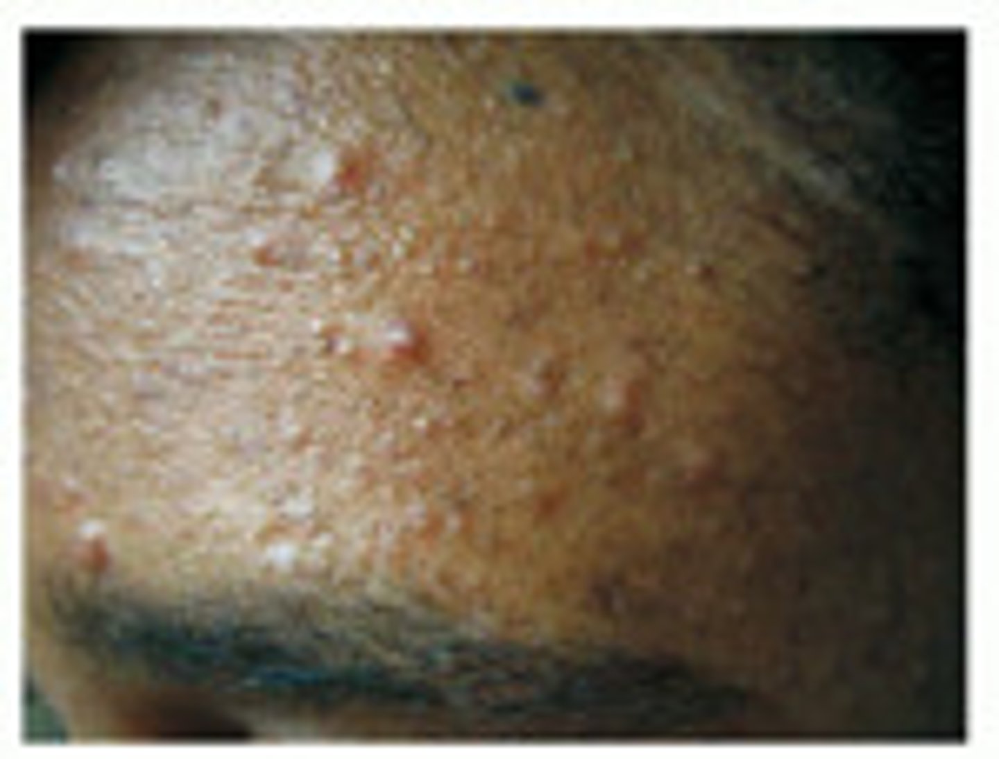 <p>forms when openings of the follicles are blocked with debris</p>