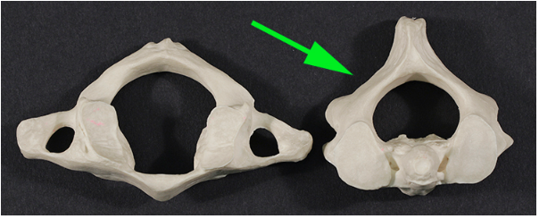 <p>What cervical vertebra is marked by the green arrow?</p>