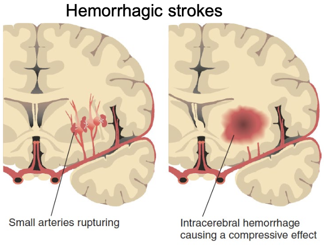 <p>→ rupture of a cerebral blood vessel, resulting in a <strong>stroke</strong></p>