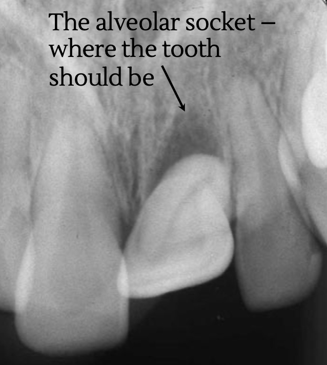 <p>tooth is displaced mesially, distally, buccally, or lingually</p><ul><li><p>often accompanied by fracture of alveolar bone</p></li><li><p>may have apical displacement</p><ul><li><p>should try to reposition tooth into socket if possible</p></li></ul></li></ul><p></p>