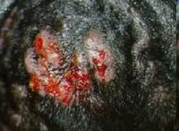 <p>Localized skin infection in a gland or hair follicle</p>