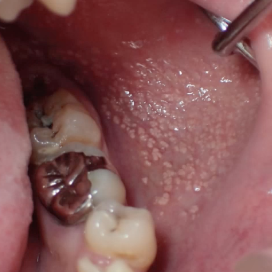 <p>which of the following is FALSE regarding this lesion: </p><p>asymptomatic </p><p>due to ectopic salivary glands </p><p>no management </p><p>can occur on the lip </p>