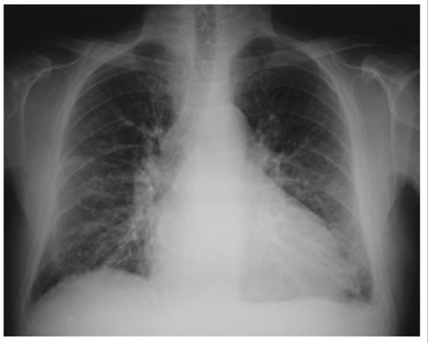 <p>Dx - what kind of CHF is this?</p>