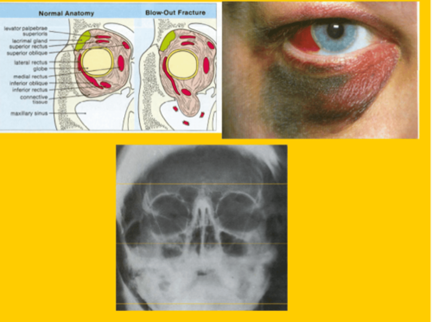 <p>Orbital swelling, ecchymosis, numbness of the lower eyelid (infraorbital nerve damage), diplopia (inferior rectus muscle is trapped)</p>