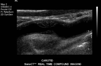 <p>Evaluate closely for the sonographic finding seen in the carotid here. </p>