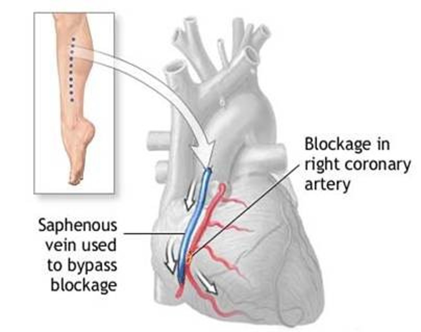 <p>=&gt; surgery involving taking a blood vessel and attaching it between the aorta (main vessel leaving heart) and a point along coronary artery, to bypass the narrow / blocked section<br><br>=&gt; results in better sleep, better mood, and more energy</p>